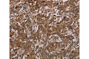 Immunohistochemistry of Human liver cancer using TBX5 Polyclonal Antibody at dilution of 1:35 (T-Box 5 Antikörper)