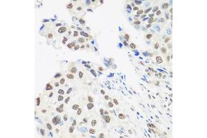 Immunohistochemistry of paraffin-embedded human prostate cancer using DDX39B antibody (ABIN5974669) at dilution of 1/100 (40x lens). (DDX39B Antikörper)