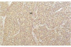 Immunohistochemistry of paraffin-embedded Human kidney carcinoma tissue using SGK1 Monoclonal Antibody at dilution of 1:200. (SGK1 Antikörper)