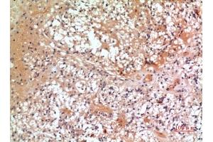 Immunohistochemical analysis of paraffin-embedded human-oophoroma, antibody was diluted at 1:100. (CMTM6 Antikörper  (C-Term))