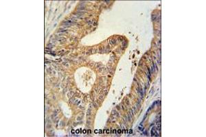 BTG1 Antibody immunohistochemistry analysis in formalin fixed and paraffin embedded human colon carcinoma followed by peroxidase conjugation of the secondary antibody and DAB staining. (BTG1 Antikörper  (AA 92-118))