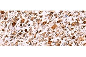 Immunohistochemistry of paraffin-embedded Human gastric cancer tissue using INO80 Polyclonal Antibody at dilution of 1:85(x200) (INO80 Antikörper)