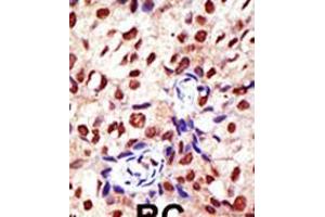 Formalin-fixed and paraffin-embedded human cancer tissue reacted with the primary antibody, which was peroxidase-conjugated to the secondary antibody, followed by DAB staining. (PRMT2 Antikörper  (N-Term))