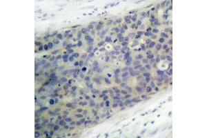 Immunohistochemistry of paraffin-embedded human breast carcinoma using Phospho-LIMK2-T505 antibody (ABIN2988124). (LIMK2 Antikörper  (pThr505))
