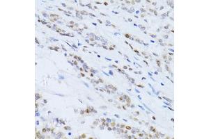 Immunohistochemistry of paraffin-embedded human colon carcinoma using CDKN1A antibody (ABIN5995726) at dilution of 1/100 (40x lens). (p21 Antikörper)