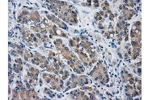Immunohistochemical staining of paraffin-embedded Carcinoma of liver tissue using anti-AKR1A1mouse monoclonal antibody. (AKR1A1 Antikörper)