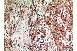 Immunohistochemistry (IHC) analysis of paraffin-embedded Human Breast Cancer, antibody was diluted at 1:100. (ZFPM2 Antikörper)