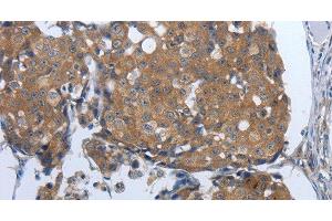Immunohistochemistry of paraffin-embedded Human breast cancer tissue using PDIA2 Polyclonal Antibody at dilution 1:50 (PDIA2 Antikörper)