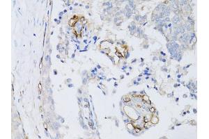Immunohistochemistry of paraffin-embedded human breast cancer using CD34 antibody (ABIN5970285) at dilution of 1:50 (40x lens). (CD34 Antikörper)