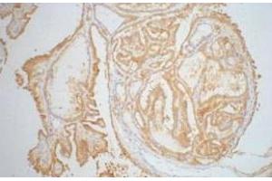 Immunohistochemistry of paraffin-embedded Human thyroid tissue using Galectin 3 Monoclonal Antibody at dilution of 1:200. (Galectin 3 Antikörper)