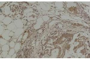 Immunohistochemistry of paraffin-embedded Human breast carcinoma tissue with Pan Methylated Lysine Monoclonal Antibody(Mix). (Methylated Lysine Antikörper)