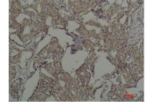 Immunohistochemical analysis of paraffin-embedded Human Breast Caricnoma using c-FosMouse mAb diluted at 1:200. (c-FOS Antikörper)