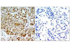 Immunohistochemical analysis of paraffin-embedded human breast carcinoma tissue, using HSP90B (Ab-254) antibody (E021290). (HSP90AB1 Antikörper)