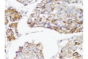 Immunohistochemistry of paraffin-embedded human liver cancer using MTOR antibody. (MTOR Antikörper)