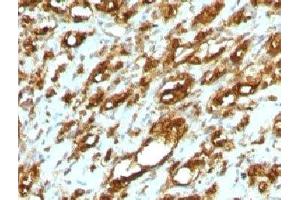 Formalin-fixed, paraffin-embedded human rhabdomyosarcoma stained with pan Muscle Actin antibody (MSA/953) (Pan Muscle Actin Antikörper)