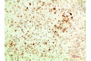 Immunohistochemical analysis of paraffin-embedded Human Ovarian Carcinoma Tissue using ATG5 Mouse mAb diluted at 1:200. (ATG5 Antikörper)