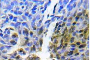 Immunohistochemistry (IHC) analyzes of Abl1 antibody in paraffin-embedded human lung adenocarcinoma tissue. (ABL1 Antikörper)