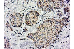 Immunohistochemical staining of paraffin-embedded Adenocarcinoma of Human breast tissue using anti-BECN1 mouse monoclonal antibody. (Beclin 1 Antikörper)