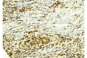 ABIN6278766 at 1/100 staining Human breast cancer tissue by IHC-P. (ZFPM2 Antikörper  (C-Term))