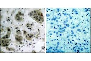 Immunohistochemistry analysis of paraffin-embedded human breast carcinoma tissue, using Akt (Ab-473) Antibody. (AKT1 Antikörper  (AA 431-480))