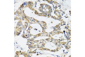 Immunohistochemistry of paraffin-embedded human colon carcinoma using SSBP1 antibody (ABIN5974202) at dilution of 1/100 (40x lens). (SSBP1 Antikörper)