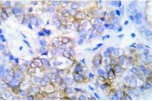 Immunohistochemistry (IHC) analyzes of HER2 pAb in paraffin-embedded human lung adenocarcinoma tissue. (ErbB2/Her2 Antikörper)