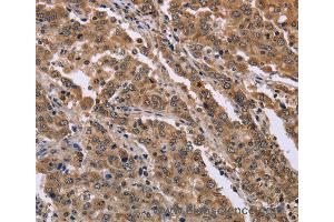 Immunohistochemistry of Human liver cancer using FAM3B Polyclonal Antibody at dilution of 1:40 (FAM3B Antikörper)