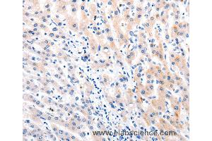Immunohistochemistry of Human liver cancer using MTOR Polyclonal Antibody at dilution of 1:60 (MTOR Antikörper)