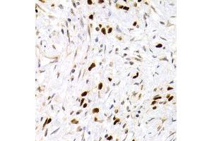 Immunohistochemistry of paraffin-embedded human gastric carcinoma using TP53 antibody at dilution of 1:200 (400x lens). (p53 Antikörper)