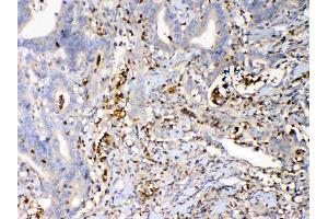 IHC analysis of Psoriasin using anti-Psoriasin antibody . (S100A7 Antikörper  (AA 2-101))