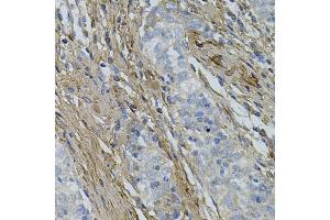 Immunohistochemistry of paraffin-embedded human esophageal cancer using COL1A1 antibody (ABIN5997480) at dilution of 1/100 (40x lens). (COL1A1 Antikörper)