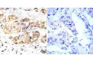 Immunohistochemical analysis of paraffin- embedded human breast carcinoma tissue using LKB1 (Ab-428) antibody (E022046). (LKB1 Antikörper)