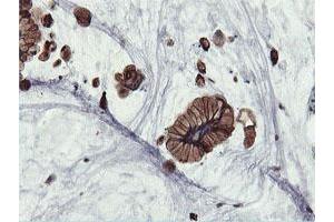 Immunohistochemical staining of paraffin-embedded Adenocarcinoma of Human colon tissue using anti-PFKP mouse monoclonal antibody. (PFKP Antikörper)