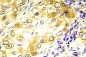 Immunohistochemistry (IHC) analyzes of P53 antibody in paraffin-embedded human lung carcinoma tissue. (p53 Antikörper)