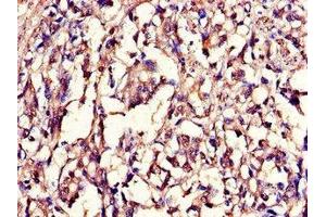 Immunohistochemistry of paraffin-embedded human gastric cancer using ABIN7157854 at dilution of 1:100 (Lamin B1 Antikörper  (AA 385-552))