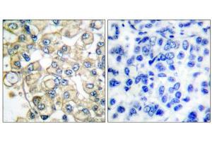 Immunohistochemical analysis of paraffin-embedded human breast carcinoma tissue, using FGFR1 Oncogene Partner antibody (ABIN5976395). (FGFR1OP Antikörper  (C-Term))