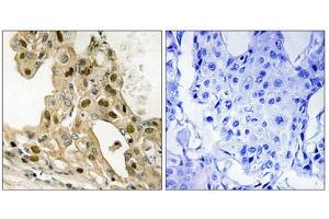 Immunohistochemistry analysis of paraffin-embedded human breast carcinoma tissue using p53 (Phospho-Thr387) antibody. (p53 Antikörper  (pThr387))