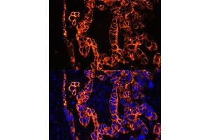 Immunofluorescence analysis of human lung cancer using Cytokeratin 7 (Cytokeratin 7 (KRT7)) antibody (ABIN6129292, ABIN6143037, ABIN6143039 and ABIN6215559) at dilution of 1:100. (Cytokeratin 7 Antikörper  (AA 1-94))