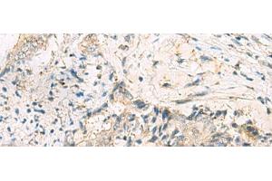 Immunohistochemistry of paraffin-embedded Human cervical cancer tissue using MGAT4B Polyclonal Antibody at dilution of 1:50(x200) (MGAT4B Antikörper)