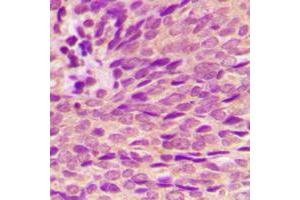 Immunohistochemical analysis of Estrogen Receptor alpha (pS118) staining in human breast cancer formalin fixed paraffin embedded tissue section. (Estrogen Receptor alpha Antikörper  (pSer118))