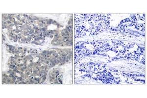 Immunohistochemical analysis of paraffin-embedded human breast carcinoma tissue using p70 S6 Kinase (phospho-Thr421) antibody (E011254). (RPS6KB1 Antikörper  (pThr421))