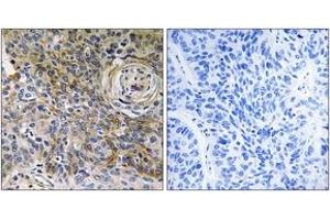 Immunohistochemistry analysis of paraffin-embedded human breast carcinoma tissue, using CD147 Antibody. (CD147 Antikörper  (AA 336-385))