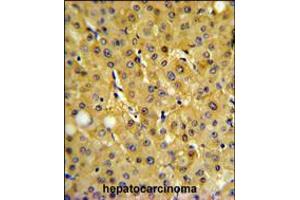 FBP1 Antibody IHC analysis in formalin fixed and paraffin embedded human hepatocarcinoma followed by peroxidase conjugation of the secondary antibody and DAB staining. (FBP1 Antikörper  (AA 125-156))