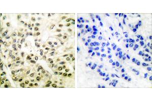 Peptide - +Immunohistochemical analysis of paraffin-embedded human breast carcinoma tissue using CREB (Ab-129/133) antibody (#B7053). (CREB1 Antikörper  (Ser129, Ser133))