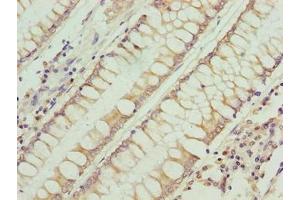 Immunohistochemistry of paraffin-embedded human colon cancer using ABIN7168228 at dilution of 1:100 (RFESD Antikörper  (AA 1-157))