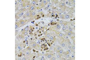 Immunohistochemistry of paraffin-embedded human liver injury using BEST1 antibody (ABIN4903043) at dilution of 1:100 (40x lens). (Bestrophin 1 Antikörper)