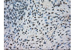 Immunohistochemical staining of paraffin-embedded Carcinoma of kidney tissue using anti-FERMT2mouse monoclonal antibody. (FERMT2 Antikörper)