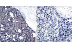 Peptide - +Immunohistochemical analysis of paraffin-embedded human breast carcinoma tissue using IκB-α (Ab-42) antibody (#B7116). (NFKBIA Antikörper  (Tyr42))