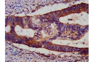 IHC image of ABIN7145547 diluted at 1:1200 and staining in paraffin-embedded human colon cancer performed on a Leica BondTM system. (BID Antikörper  (AA 1-195))
