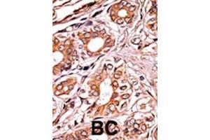 Formalin-fixed and paraffin-embedded human cancer tissue reacted with the primary antibody, which was peroxidase-conjugated to the secondary antibody, followed by AEC staining. (Retinoblastoma 1 Antikörper  (pSer249))